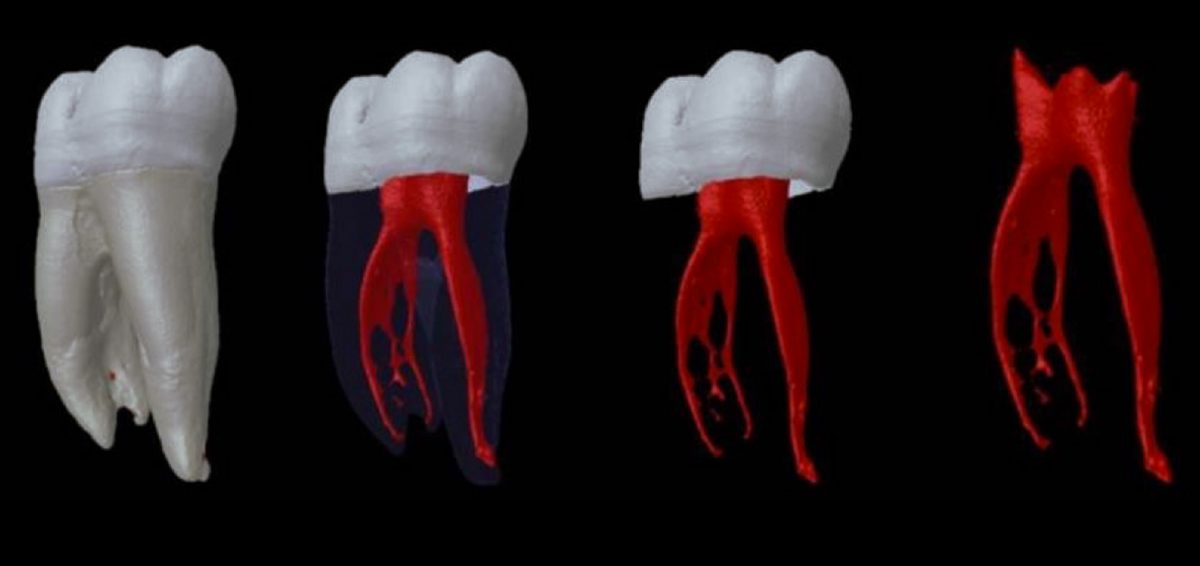 Zahnarzt Dr.med.dent. Alexander Schnotz Zahnwurzeln Vielfalt an Kanälen — Zahnarzt Dr.med.dent Zahnarzt Dr.med.dent. Alexander Schnotz Zahnwurzeln Vielfalt an Kanälen — Zahnarzt Dr.med.dent