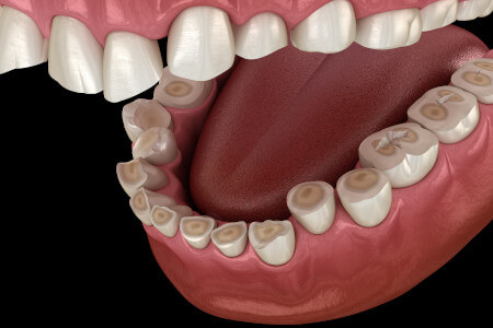 Um den Nerv vor den äußeren Reizen zu schützen, bildet der Zahn vermehrt neues Dentin. Die Nervenhöhle wird durch Mineralablagerungen immer kleiner und die "verglast".